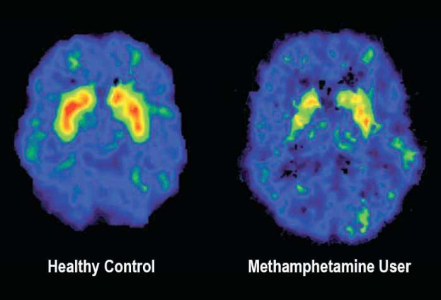 Side-by-side-MRI-Aufnahmen eines gesunden Gehirns (links) und eines Gehirns, das von Methamphetaminmissbrauch betroffen ist (rechts).